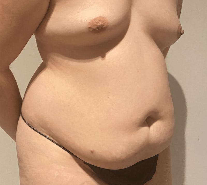 Tummy Tuck Before & After Gallery - Patient 376638 - Image 3