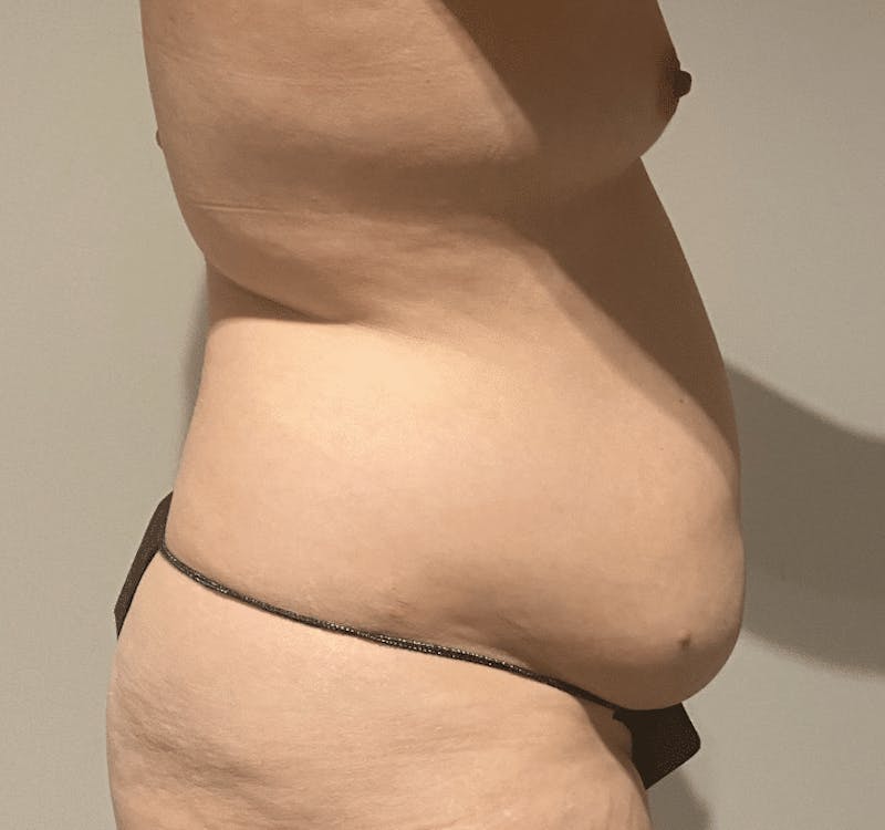 Tummy Tuck Before & After Gallery - Patient 376638 - Image 7