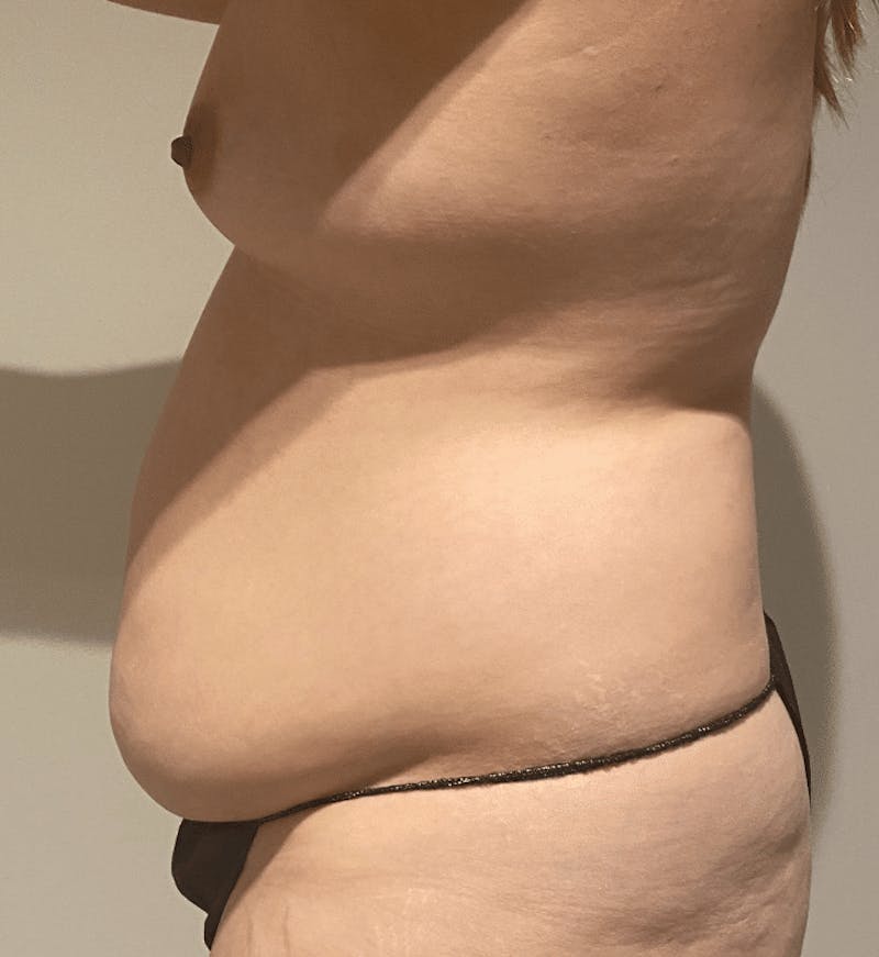 Tummy Tuck Before & After Gallery - Patient 376638 - Image 9