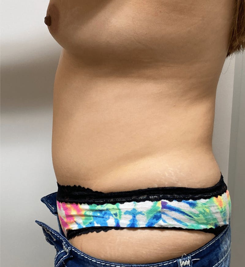 Tummy Tuck Before & After Gallery - Patient 376638 - Image 10