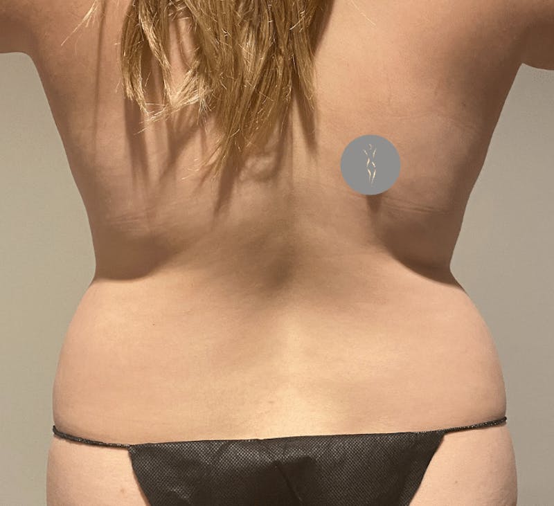 Tummy Tuck Before & After Gallery - Patient 376638 - Image 11
