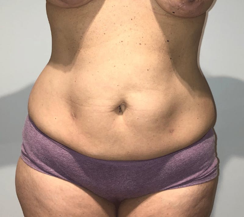 Tummy Tuck Before & After Gallery - Patient 223245 - Image 1