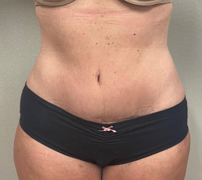 Tummy Tuck Before & After Gallery - Patient 223245 - Image 2