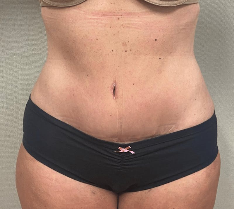 Tummy Tuck Before & After Gallery - Patient 223245 - Image 2