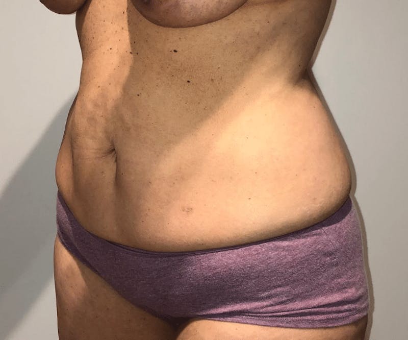 Tummy Tuck Before & After Gallery - Patient 223245 - Image 3