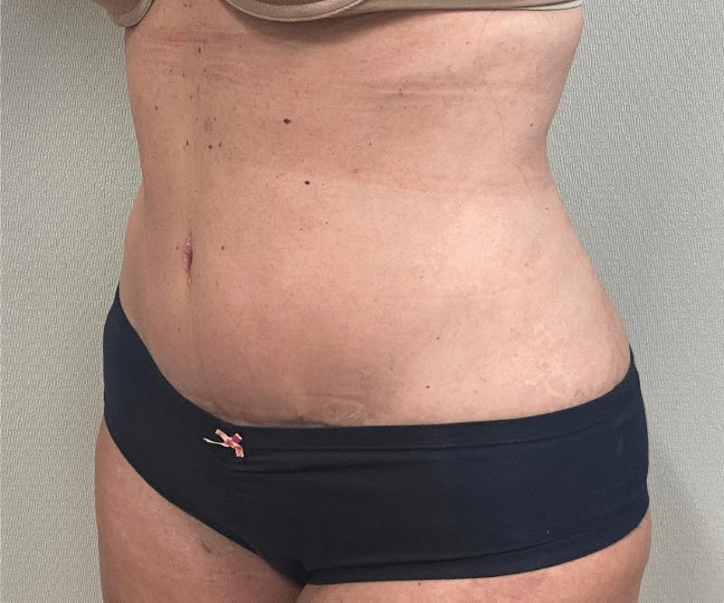 Tummy Tuck Before & After Gallery - Patient 223245 - Image 4