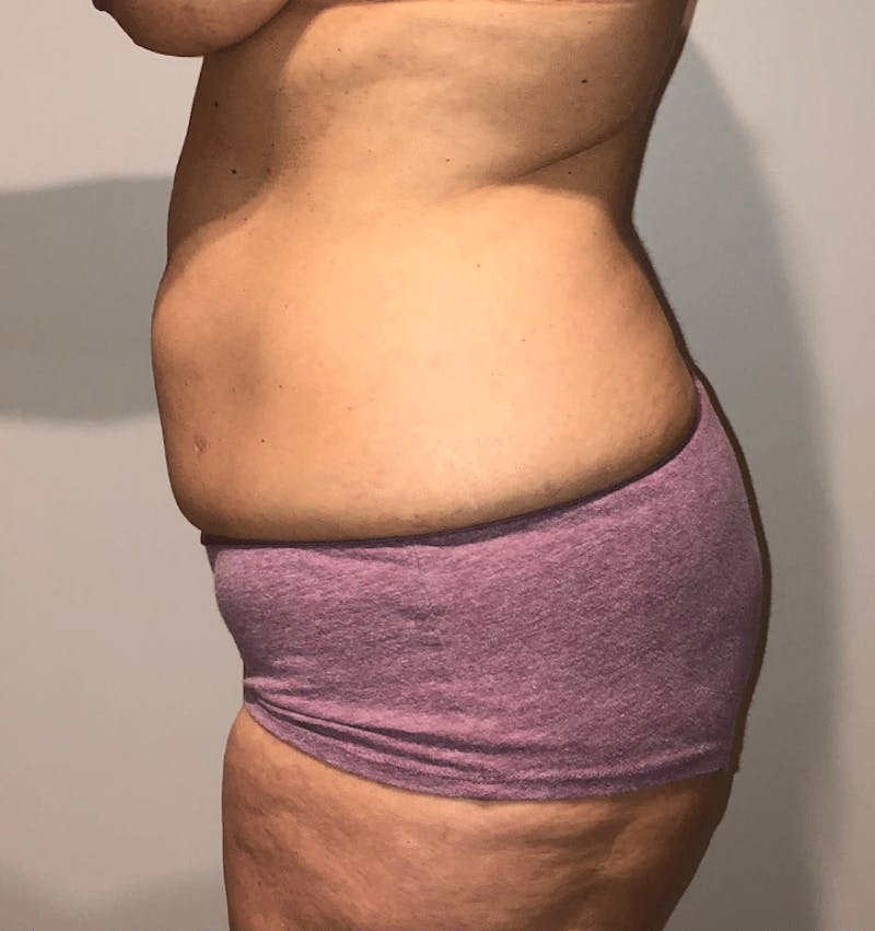 Tummy Tuck Before & After Gallery - Patient 223245 - Image 5