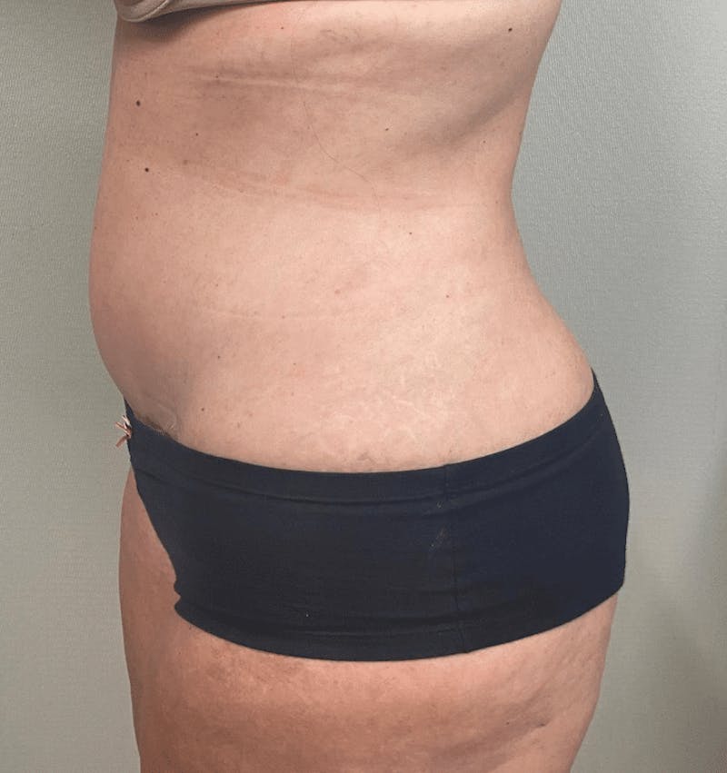 Tummy Tuck Before & After Gallery - Patient 223245 - Image 6