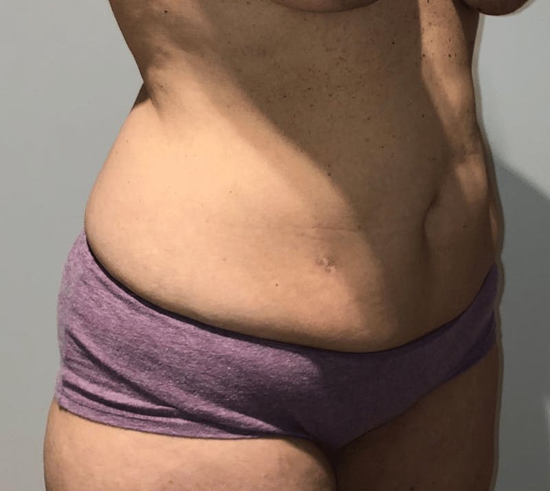 Tummy Tuck Before & After Gallery - Patient 223245 - Image 7