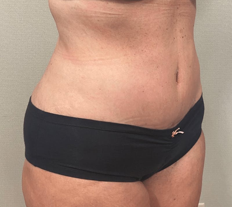 Tummy Tuck Before & After Gallery - Patient 223245 - Image 8
