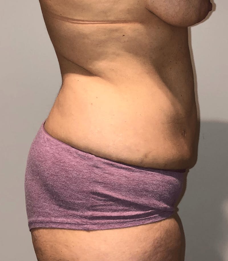 Tummy Tuck Before & After Gallery - Patient 223245 - Image 9
