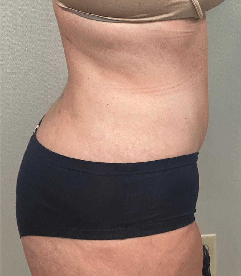 Tummy Tuck Before & After Gallery - Patient 223245 - Image 10