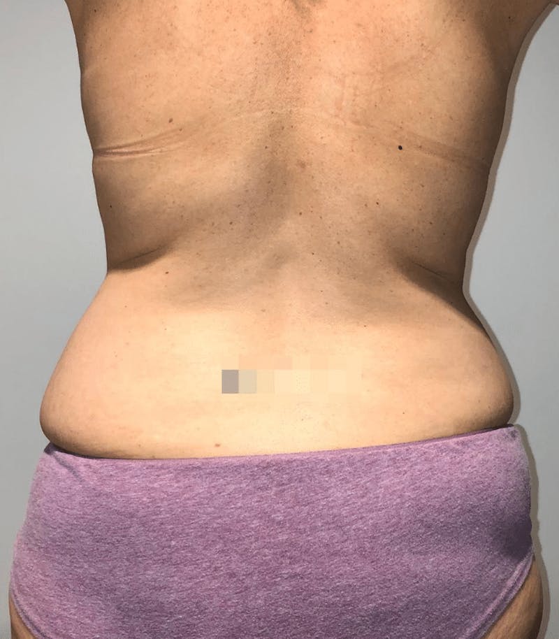 Tummy Tuck Before & After Gallery - Patient 223245 - Image 11
