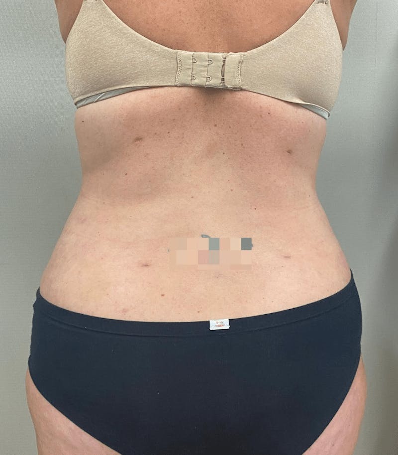 Tummy Tuck Before & After Gallery - Patient 223245 - Image 12