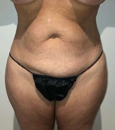 Tummy Tuck Before & After Gallery - Patient 684112 - Image 1