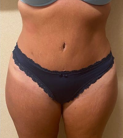 Tummy Tuck Before & After Gallery - Patient 684112 - Image 2