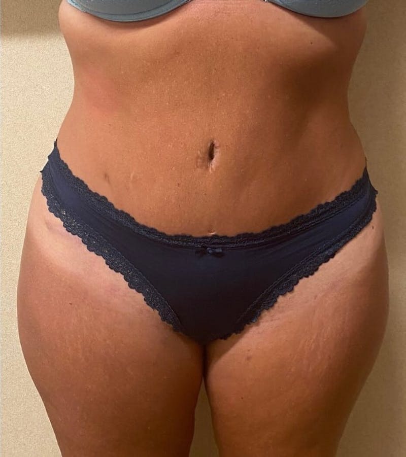 Tummy Tuck Before & After Gallery - Patient 684112 - Image 2