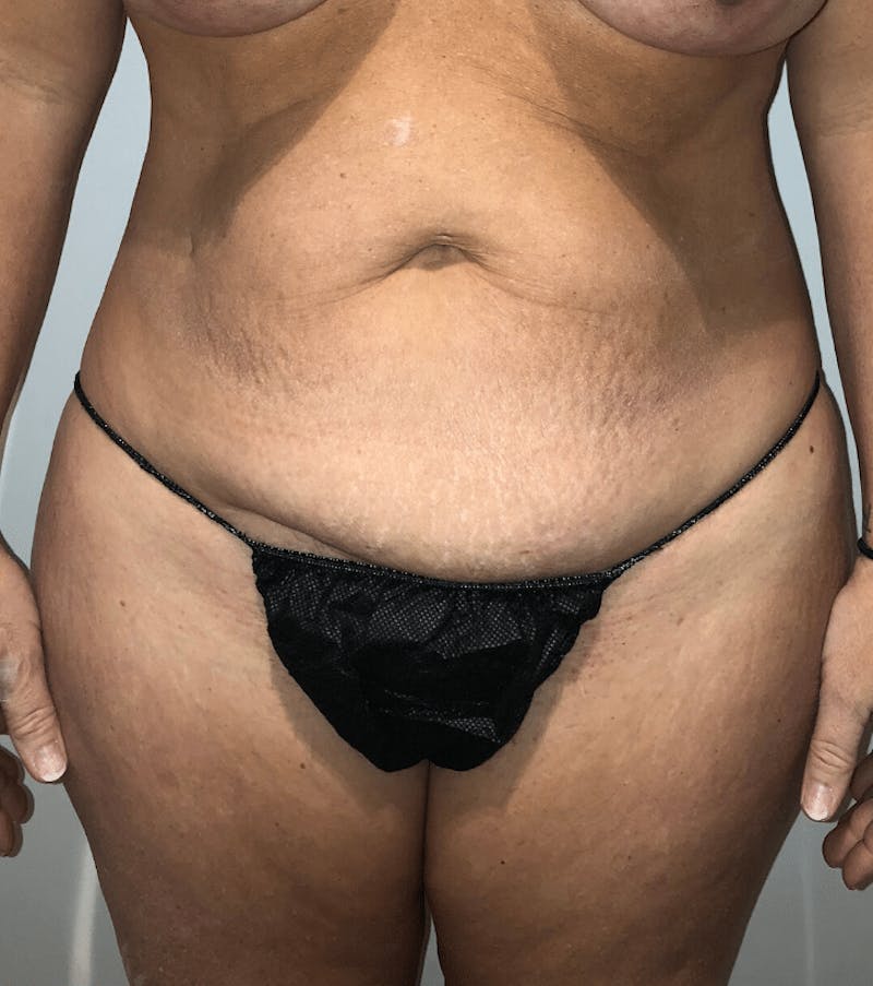 Tummy Tuck Before & After Gallery - Patient 684112 - Image 3