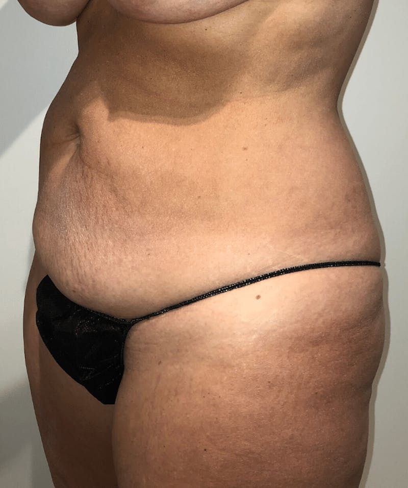 Tummy Tuck Before & After Gallery - Patient 684112 - Image 5