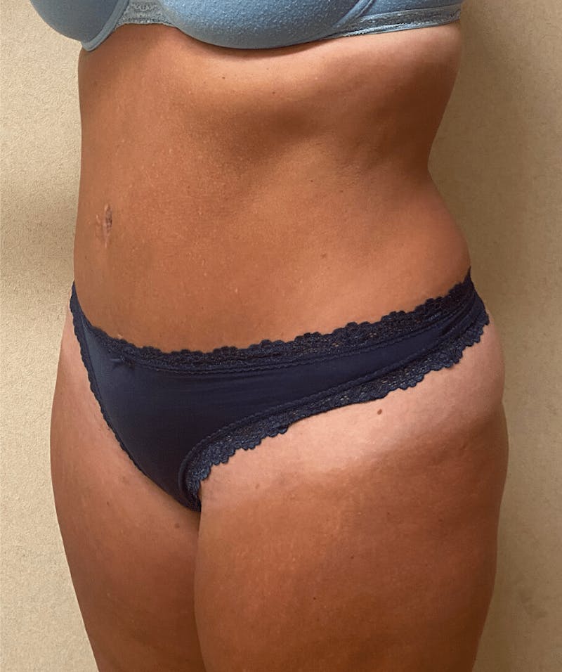 Tummy Tuck Before & After Gallery - Patient 684112 - Image 6