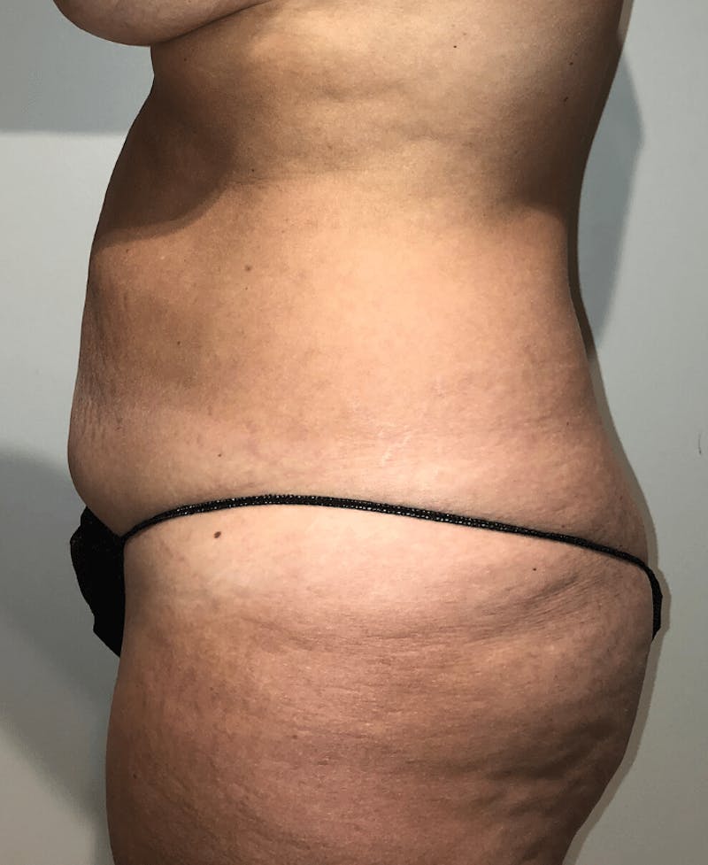 Tummy Tuck Before & After Gallery - Patient 684112 - Image 7