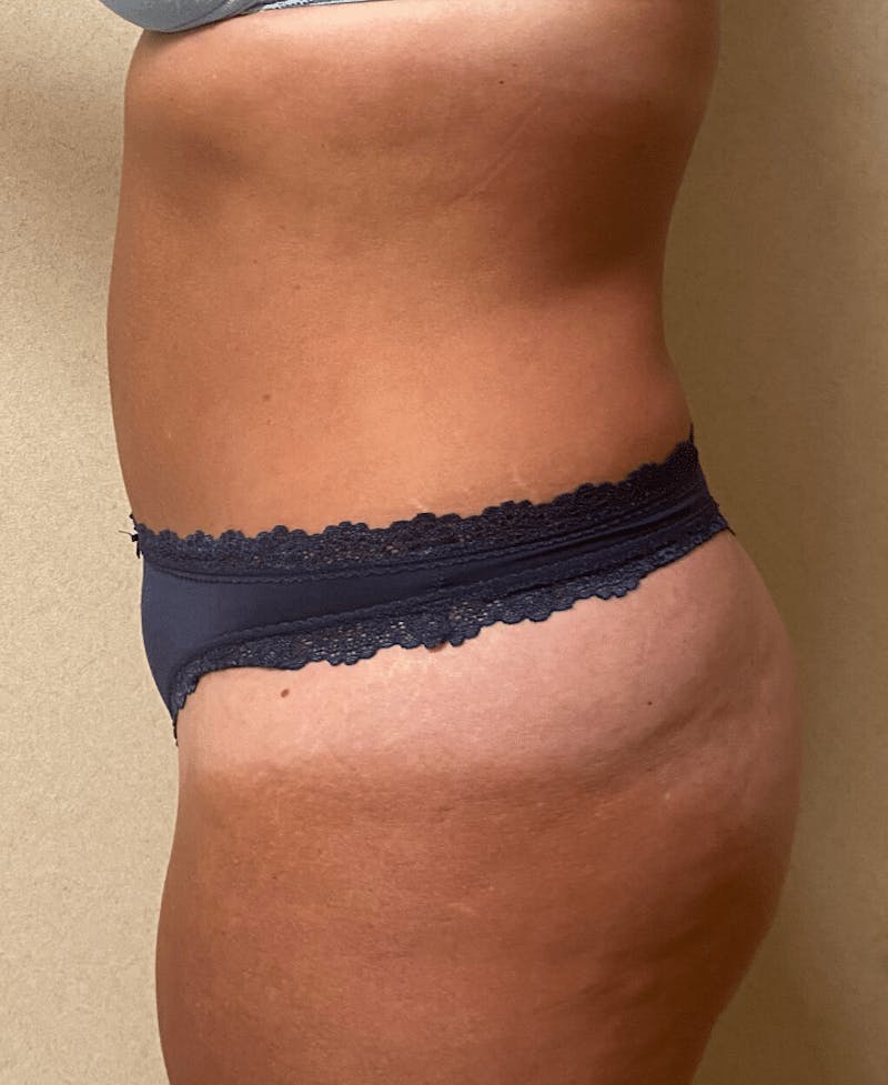 Tummy Tuck Before & After Gallery - Patient 684112 - Image 8