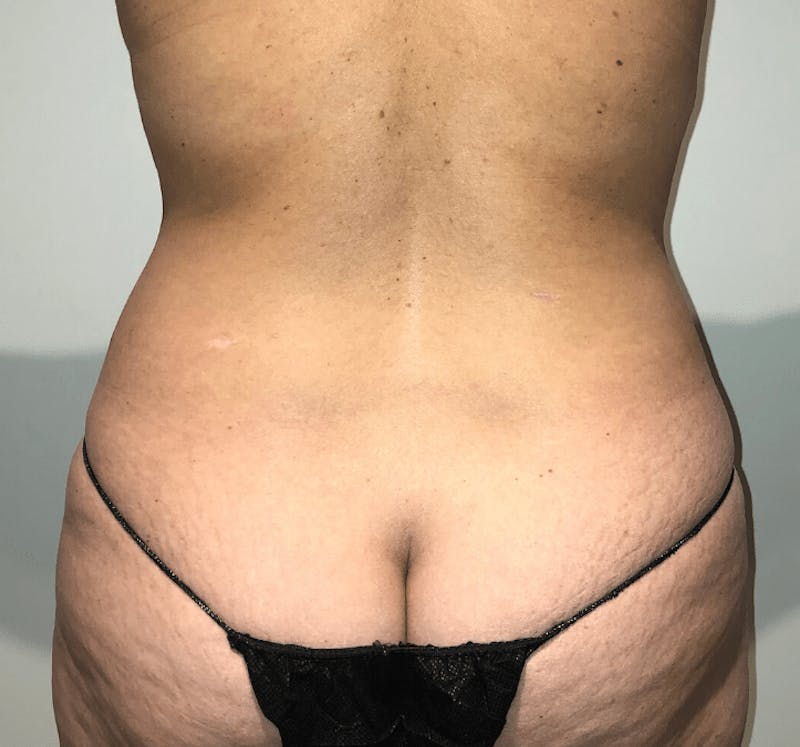 Tummy Tuck Before & After Gallery - Patient 684112 - Image 9