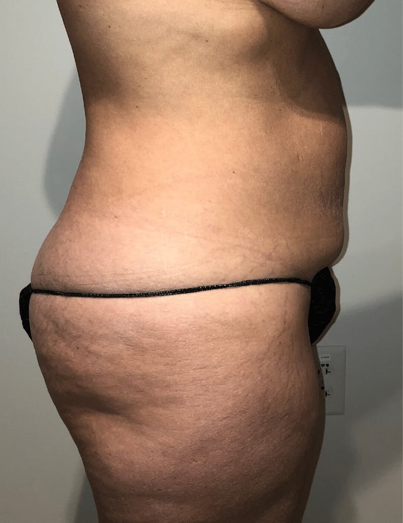 Tummy Tuck Before & After Gallery - Patient 684112 - Image 11