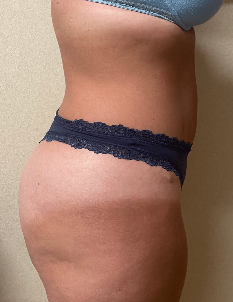 Tummy Tuck Before & After Gallery - Patient 684112 - Image 12