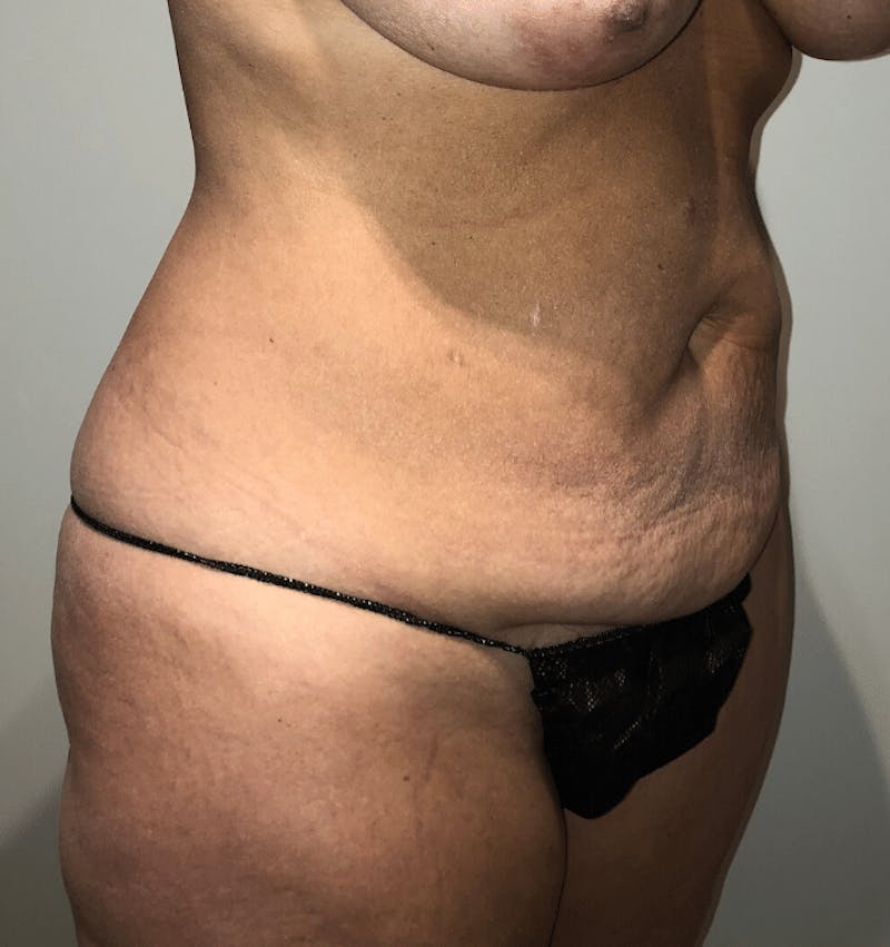 Tummy Tuck Before & After Gallery - Patient 684112 - Image 13