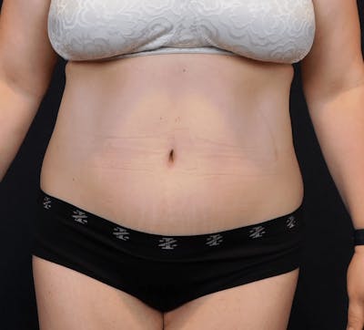 Tummy Tuck Before & After Gallery - Patient 388390 - Image 2