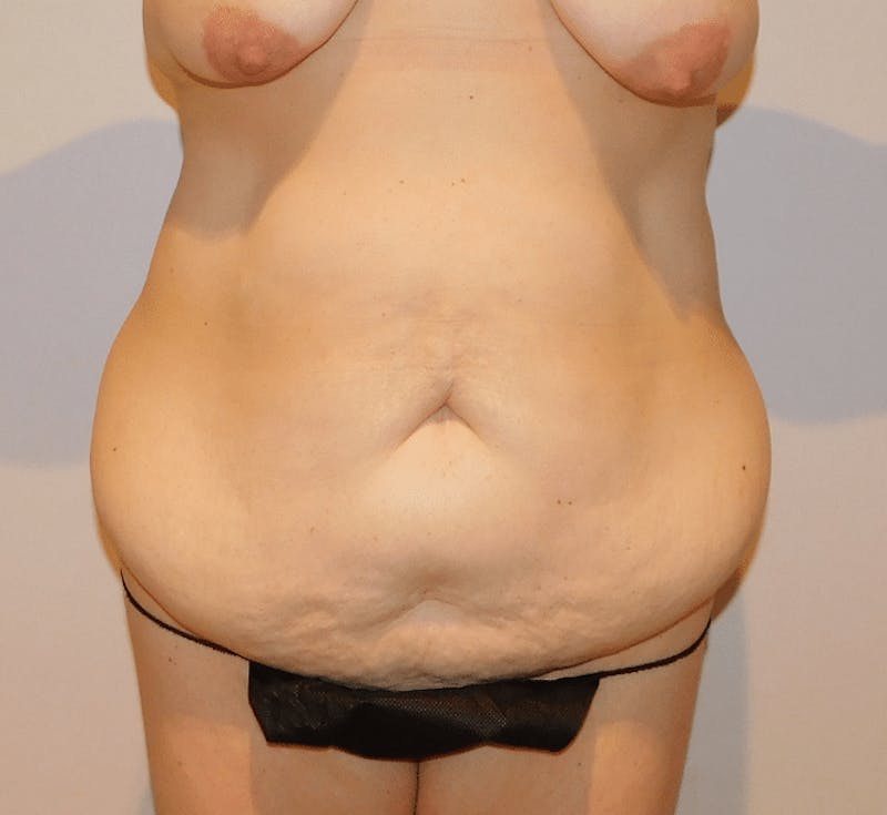 Tummy Tuck Before & After Gallery - Patient 388390 - Image 3