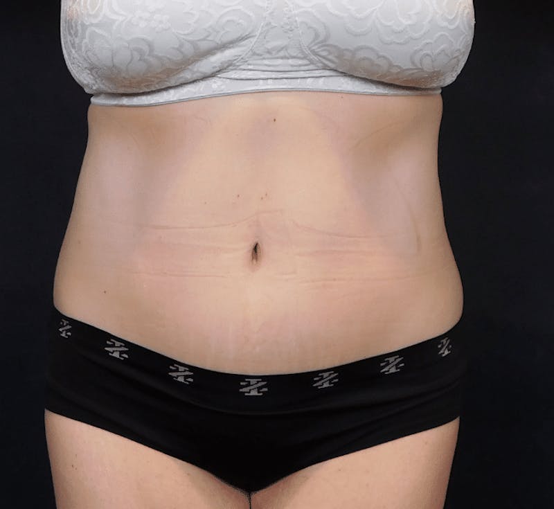 Tummy Tuck Before & After Gallery - Patient 388390 - Image 4