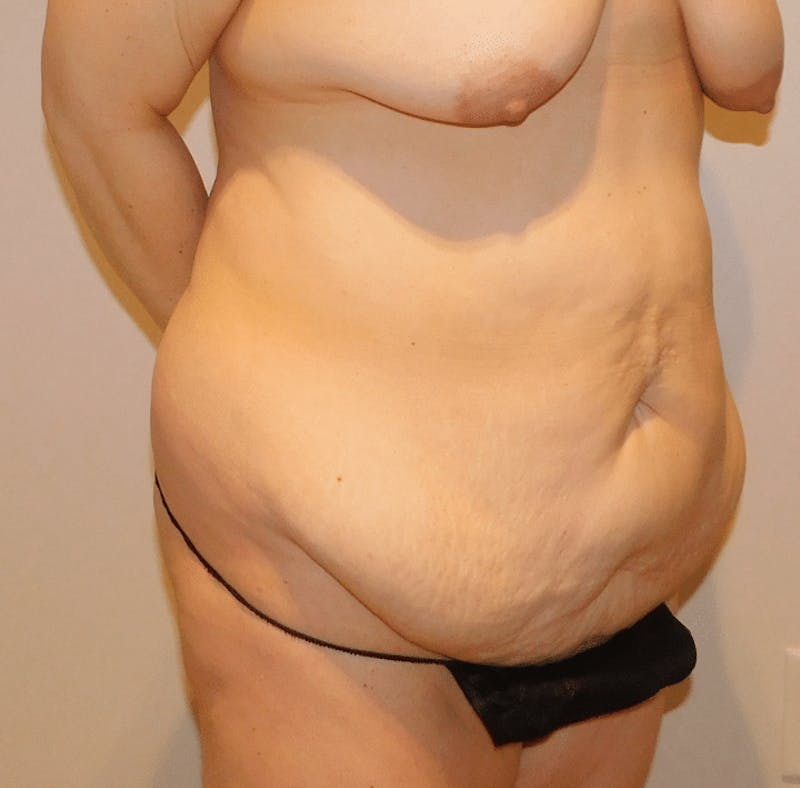 Tummy Tuck Before & After Gallery - Patient 388390 - Image 5