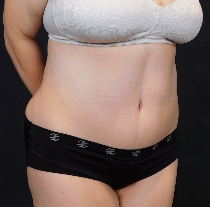 Tummy Tuck Before & After Gallery - Patient 388390 - Image 6