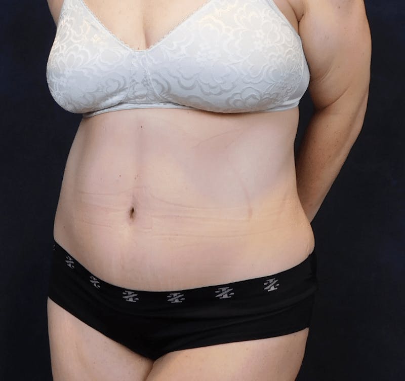 Tummy Tuck Before & After Gallery - Patient 388390 - Image 8