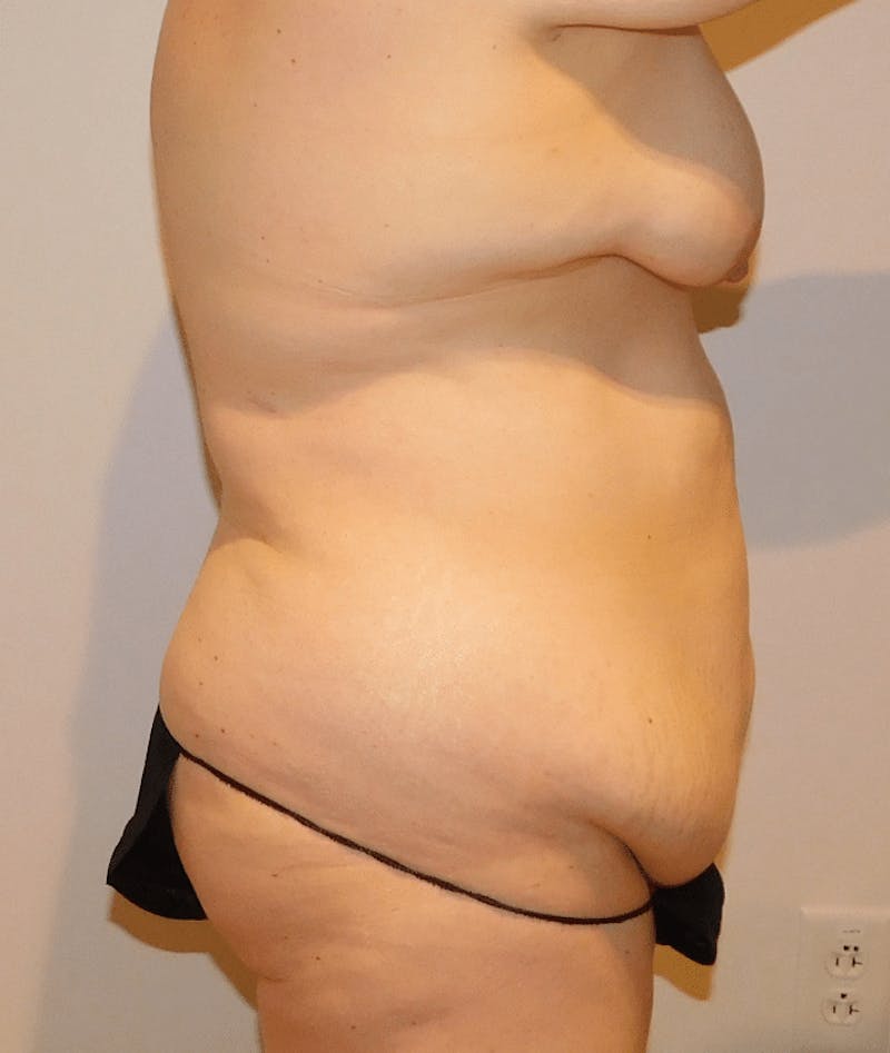 Tummy Tuck Before & After Gallery - Patient 388390 - Image 9