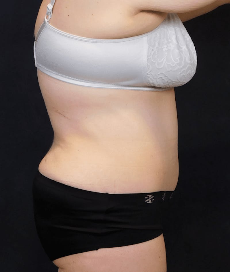 Tummy Tuck Before & After Gallery - Patient 388390 - Image 10