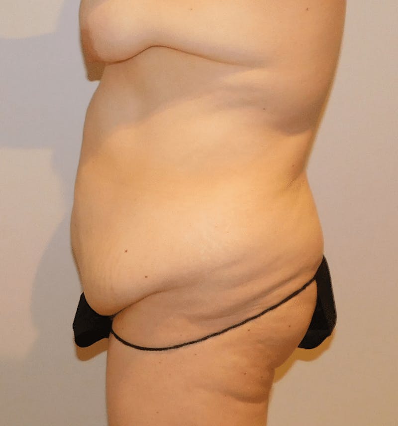 Tummy Tuck Before & After Gallery - Patient 388390 - Image 11