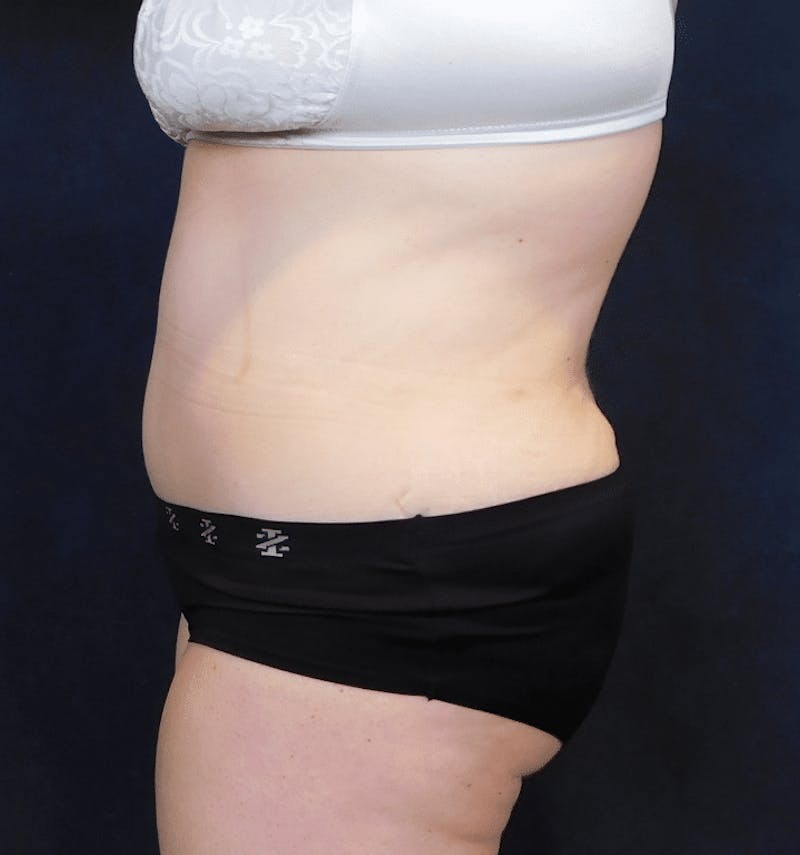 Tummy Tuck Before & After Gallery - Patient 388390 - Image 12
