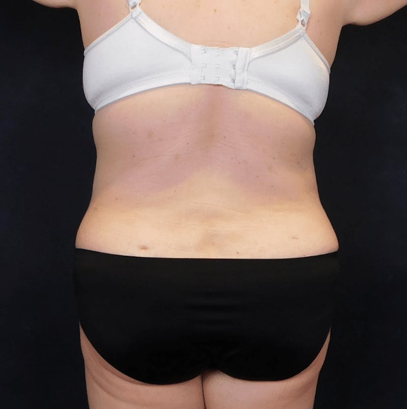 Tummy Tuck Before & After Gallery - Patient 388390 - Image 14