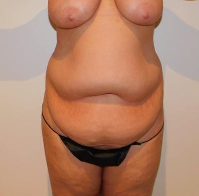 Mommy Makeover Before & After Gallery - Patient 288407 - Image 1