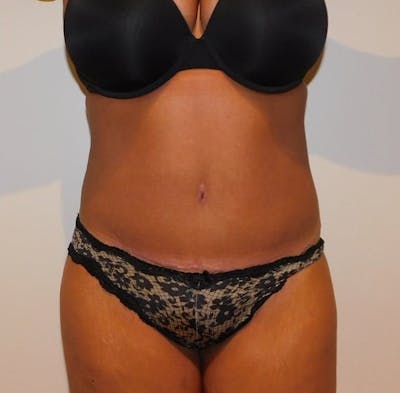 Mommy Makeover Before & After Gallery - Patient 288407 - Image 2