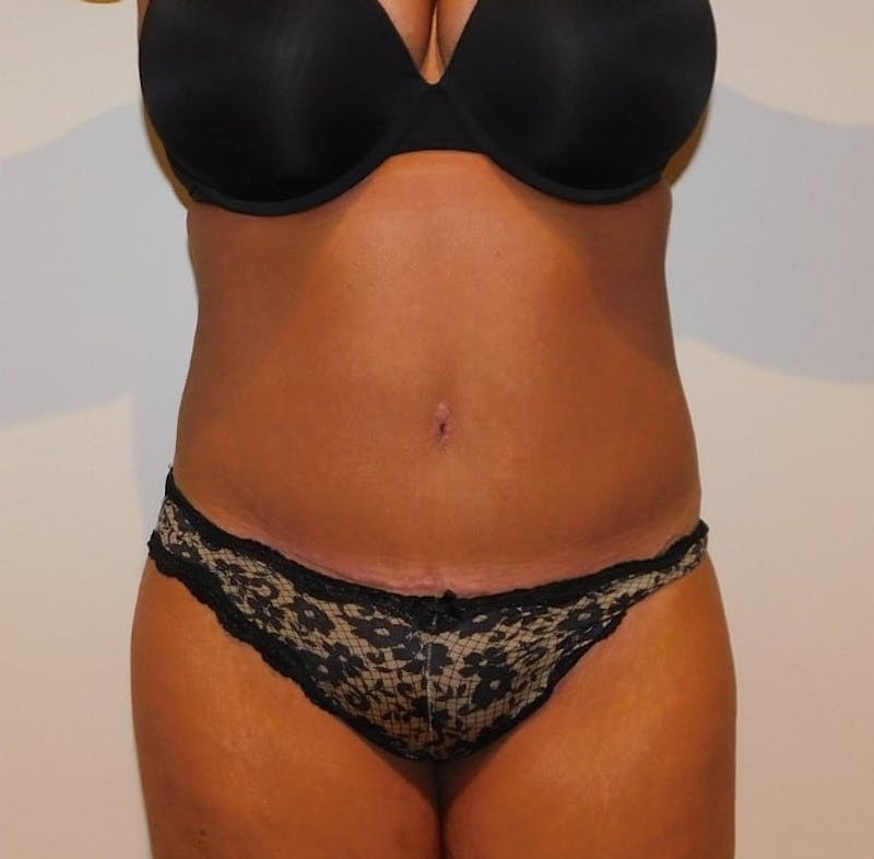Mommy Makeover Before & After Gallery - Patient 288407 - Image 2
