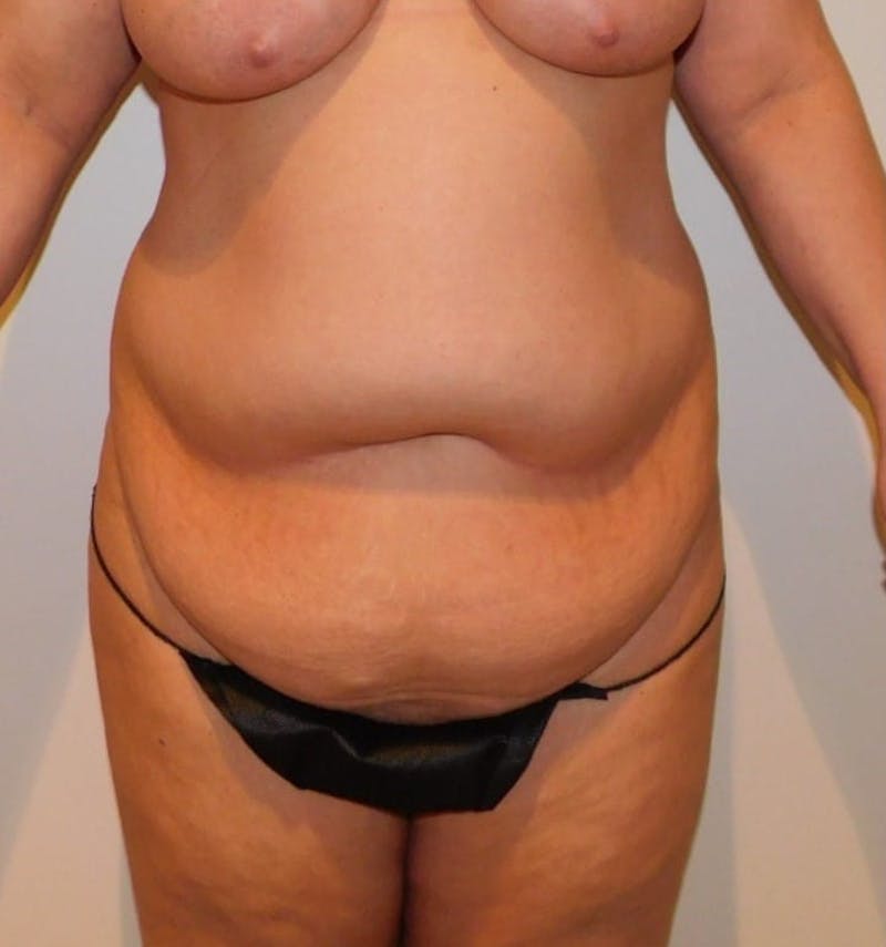 Mommy Makeover Before & After Gallery - Patient 288407 - Image 3