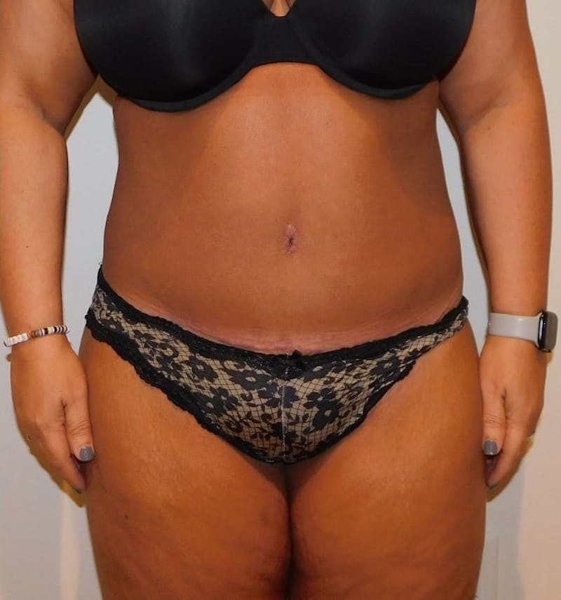 Mommy Makeover Before & After Gallery - Patient 288407 - Image 4