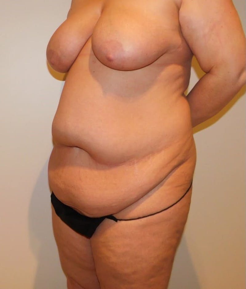 Mommy Makeover Before & After Gallery - Patient 288407 - Image 5