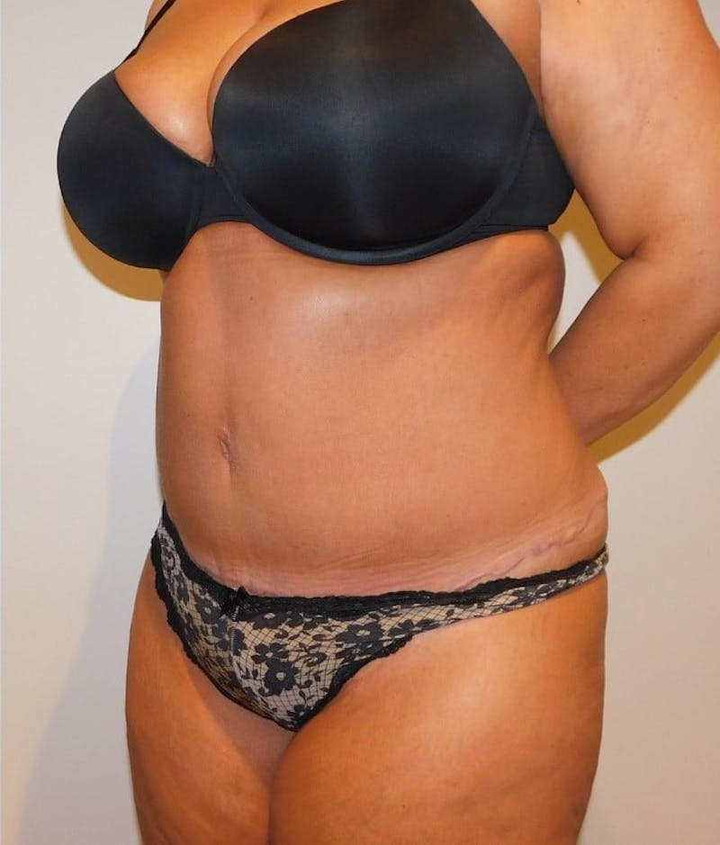 Mommy Makeover Before & After Gallery - Patient 288407 - Image 6