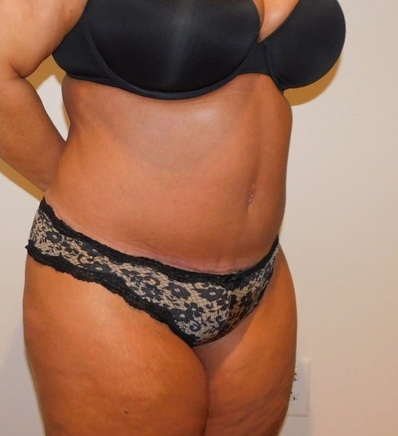 Mommy Makeover Before & After Gallery - Patient 288407 - Image 8