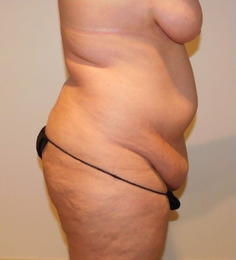 Mommy Makeover Before & After Gallery - Patient 288407 - Image 9
